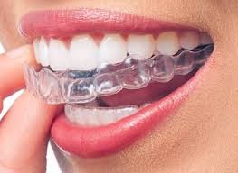 Aligners