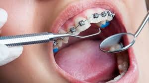 Orthodontic Treatment