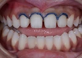  Veneers
